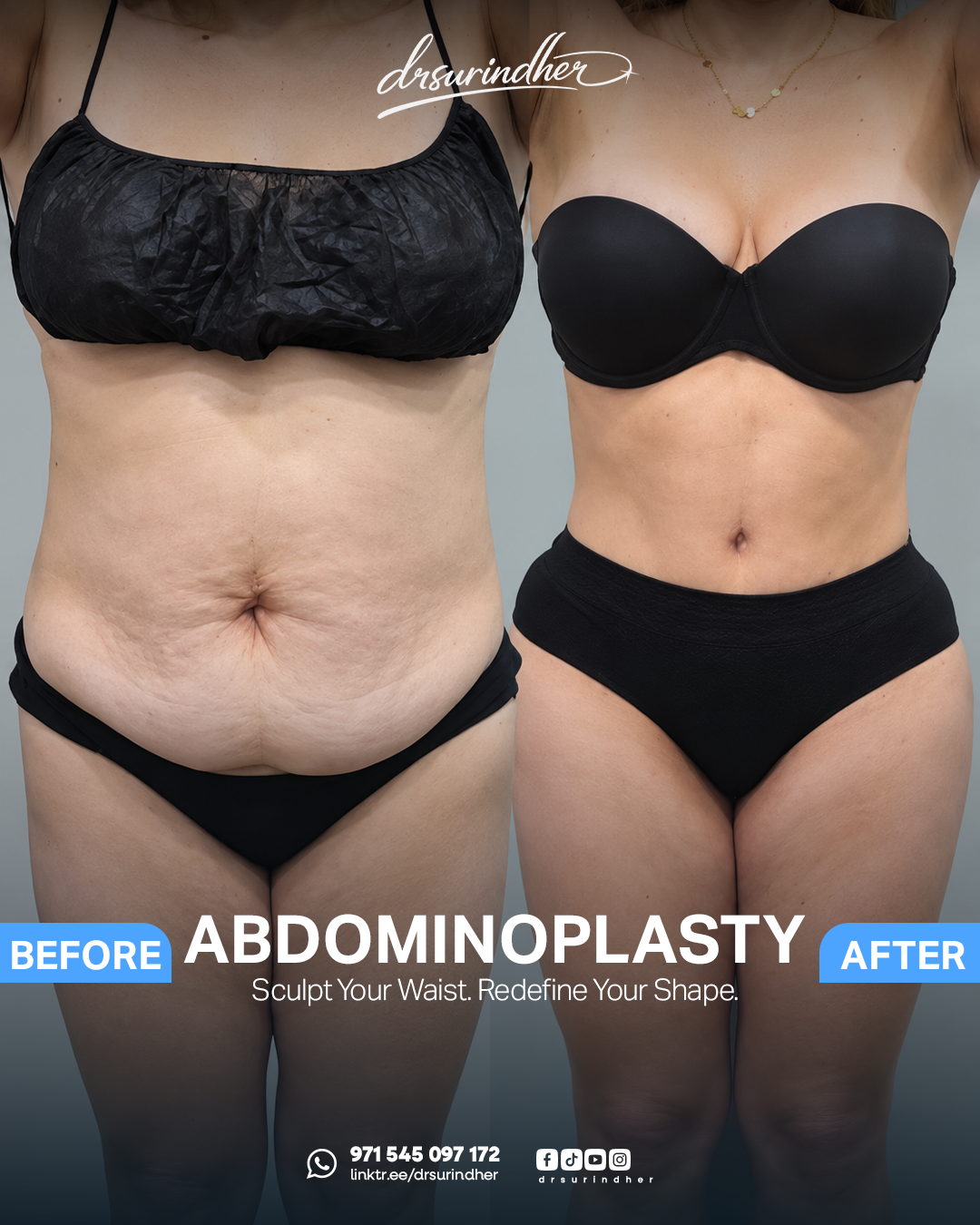Abdominoplasty before and after comparison, front view