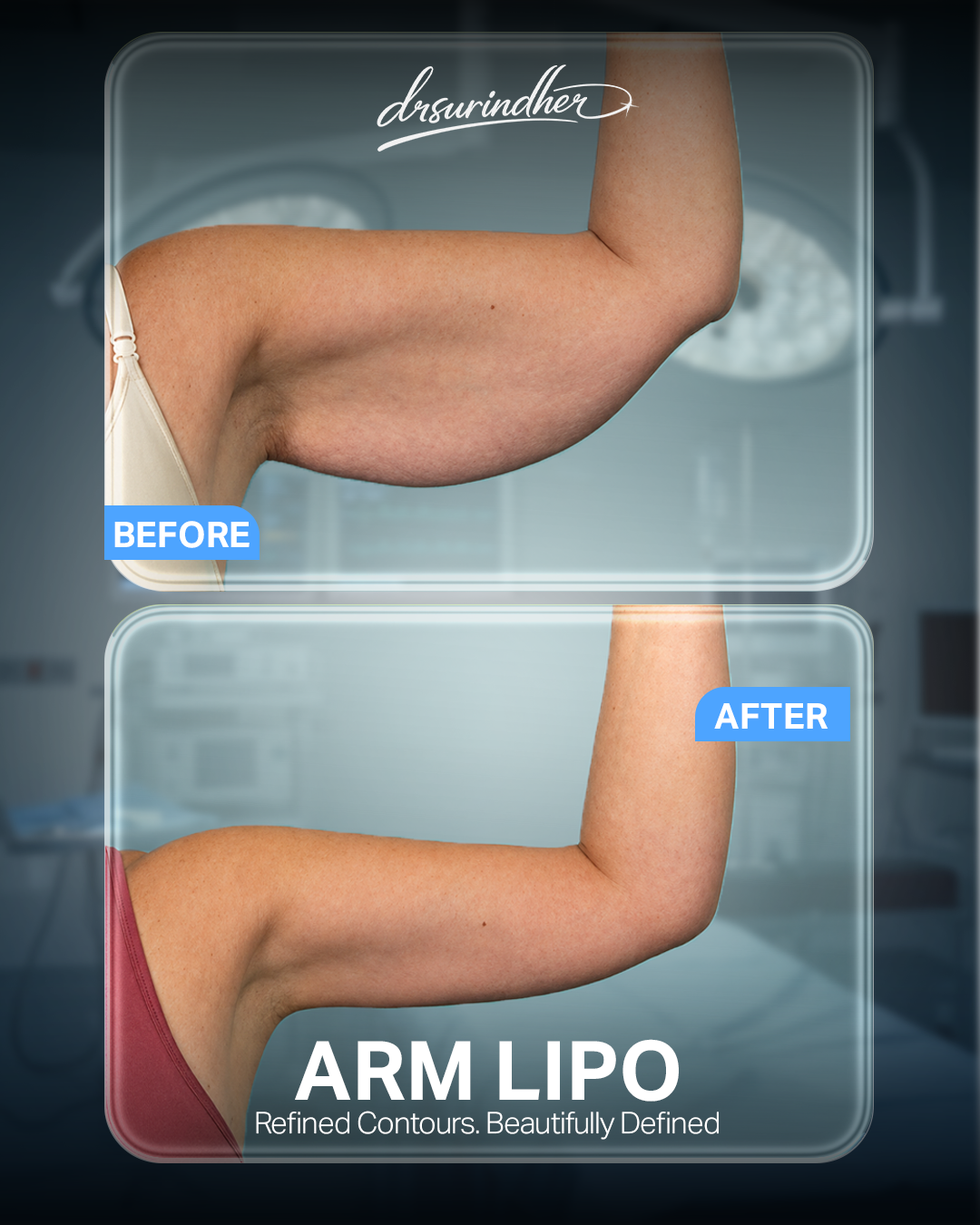 Arm liposuction before and after comparison of the upper arm
