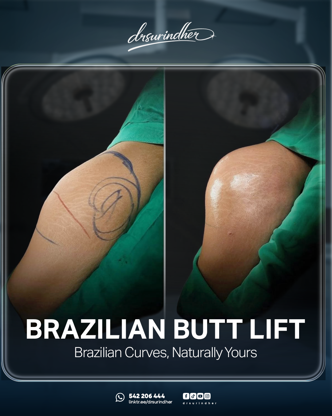 Brazilian butt lift before and after comparison during surgery