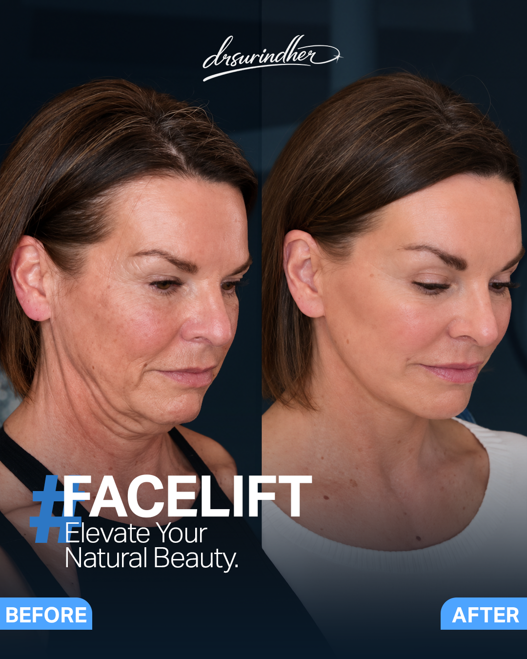Facelift before and after comparison, three-quarter view