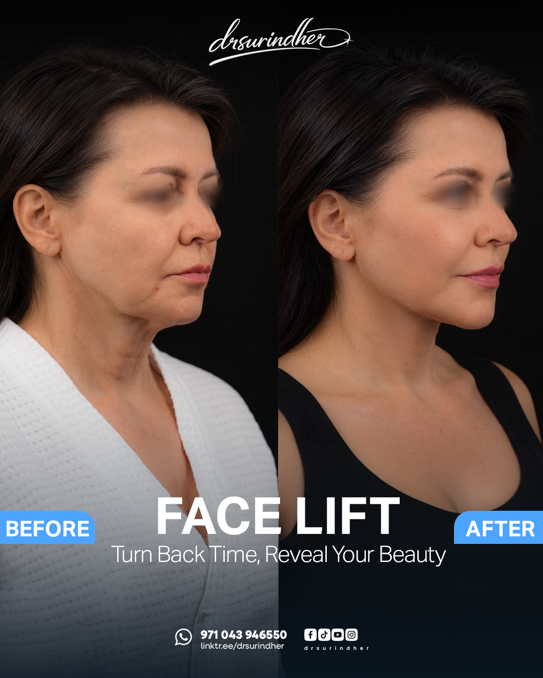 Face lift before and after comparison, side profile