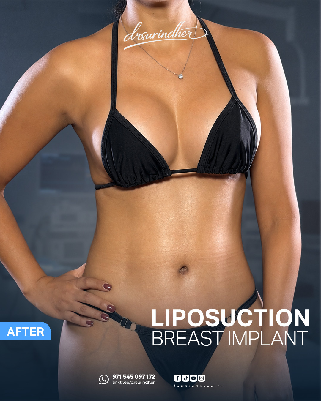 After liposuction and breast implant, front view