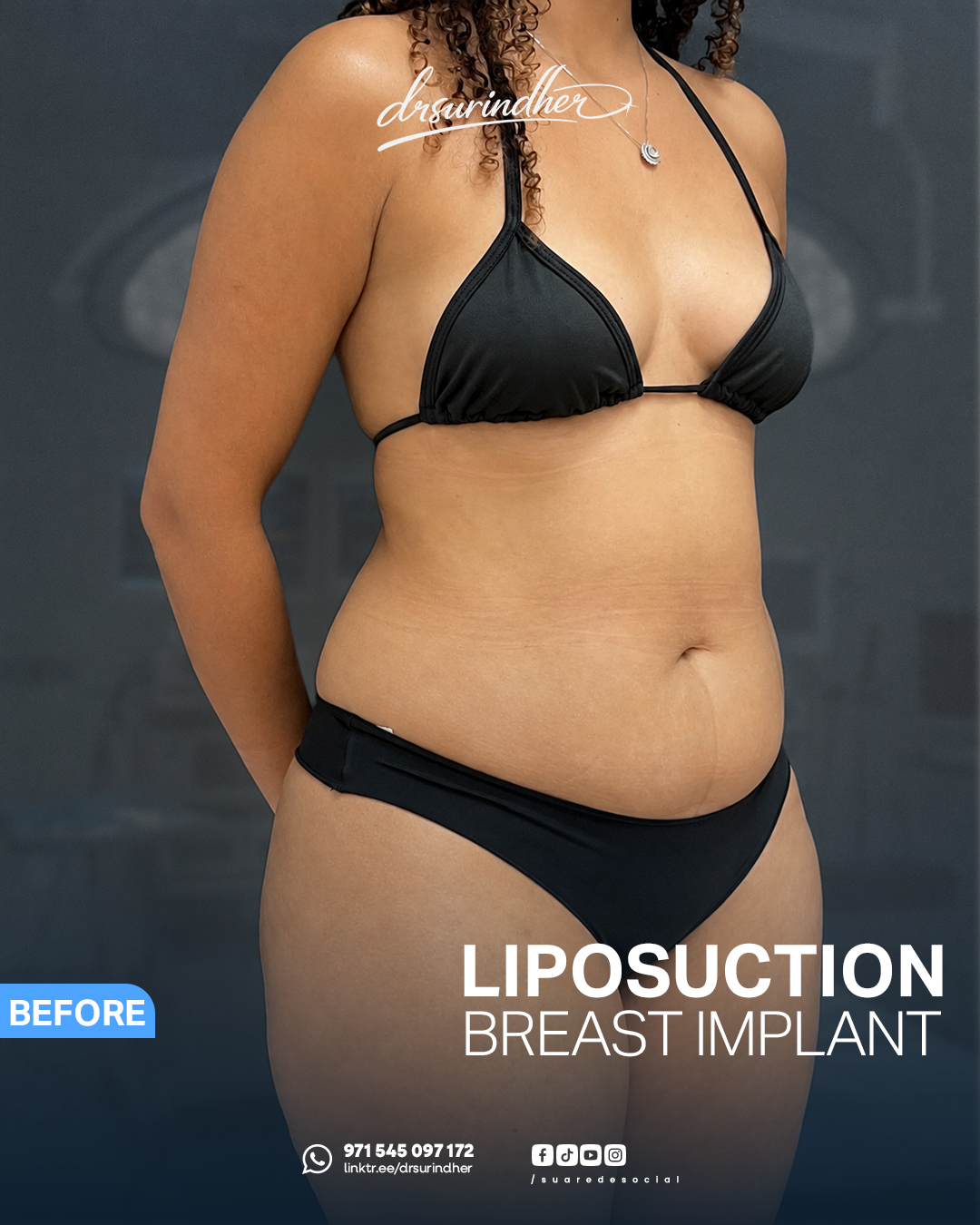 Before liposuction and breast implant, three-quarter view