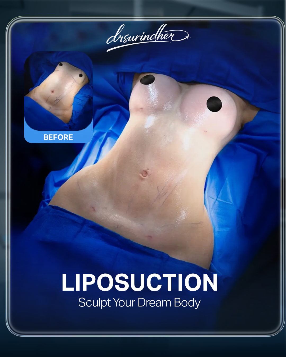 Liposuction result with a smaller before image inset, shown on the operating table
