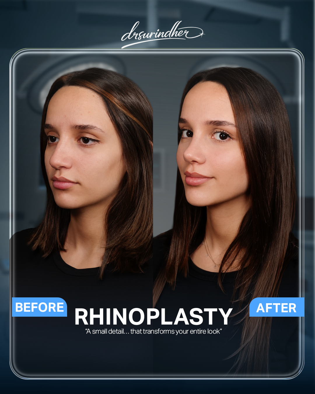 Rhinoplasty before and after comparison, three-quarter view