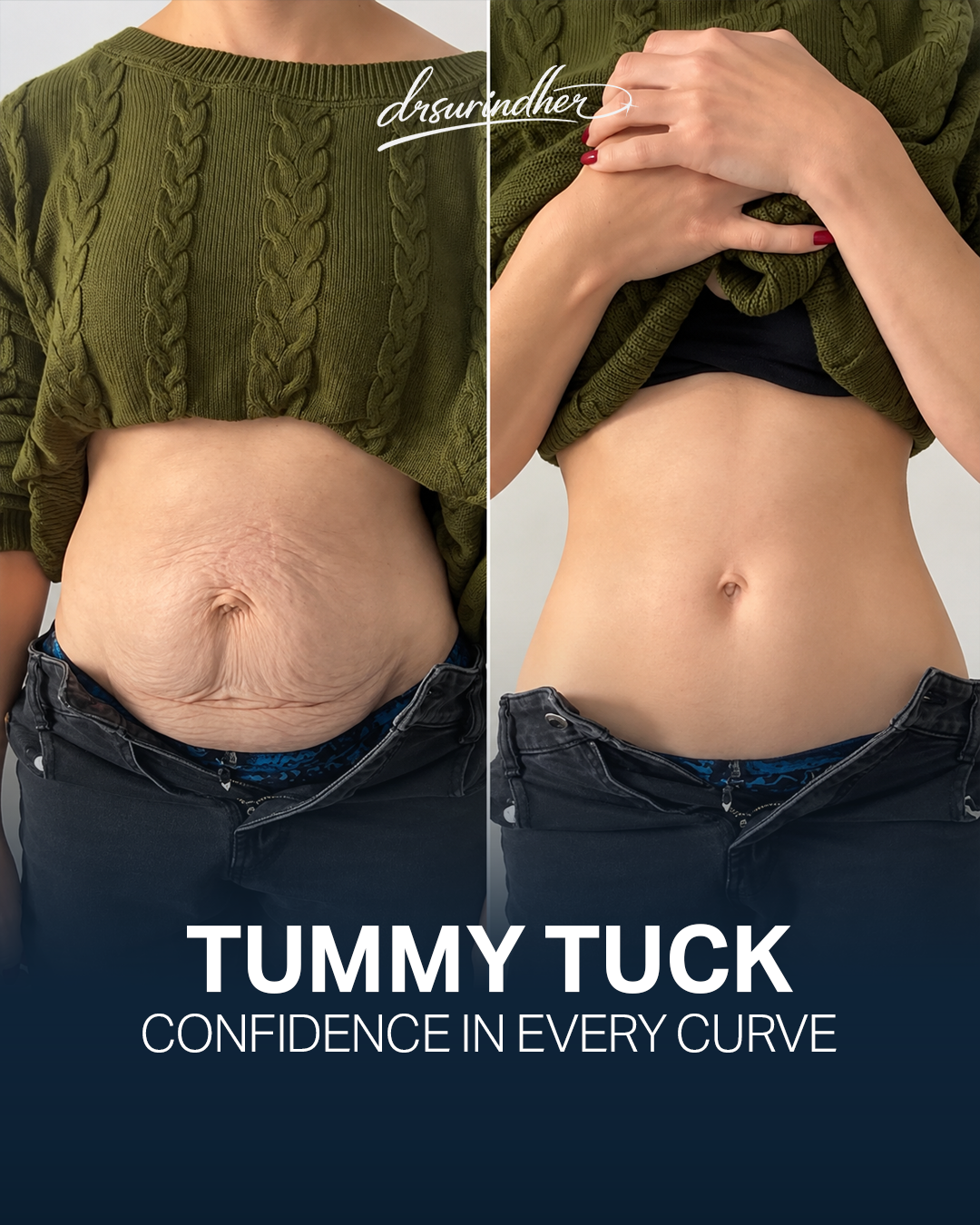 Tummy tuck before and after comparison of the abdomen